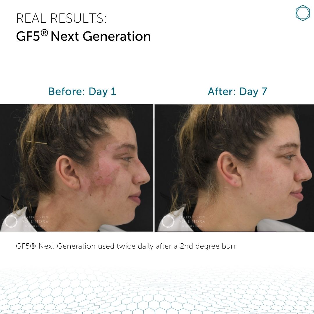 GF5 Next Generation®