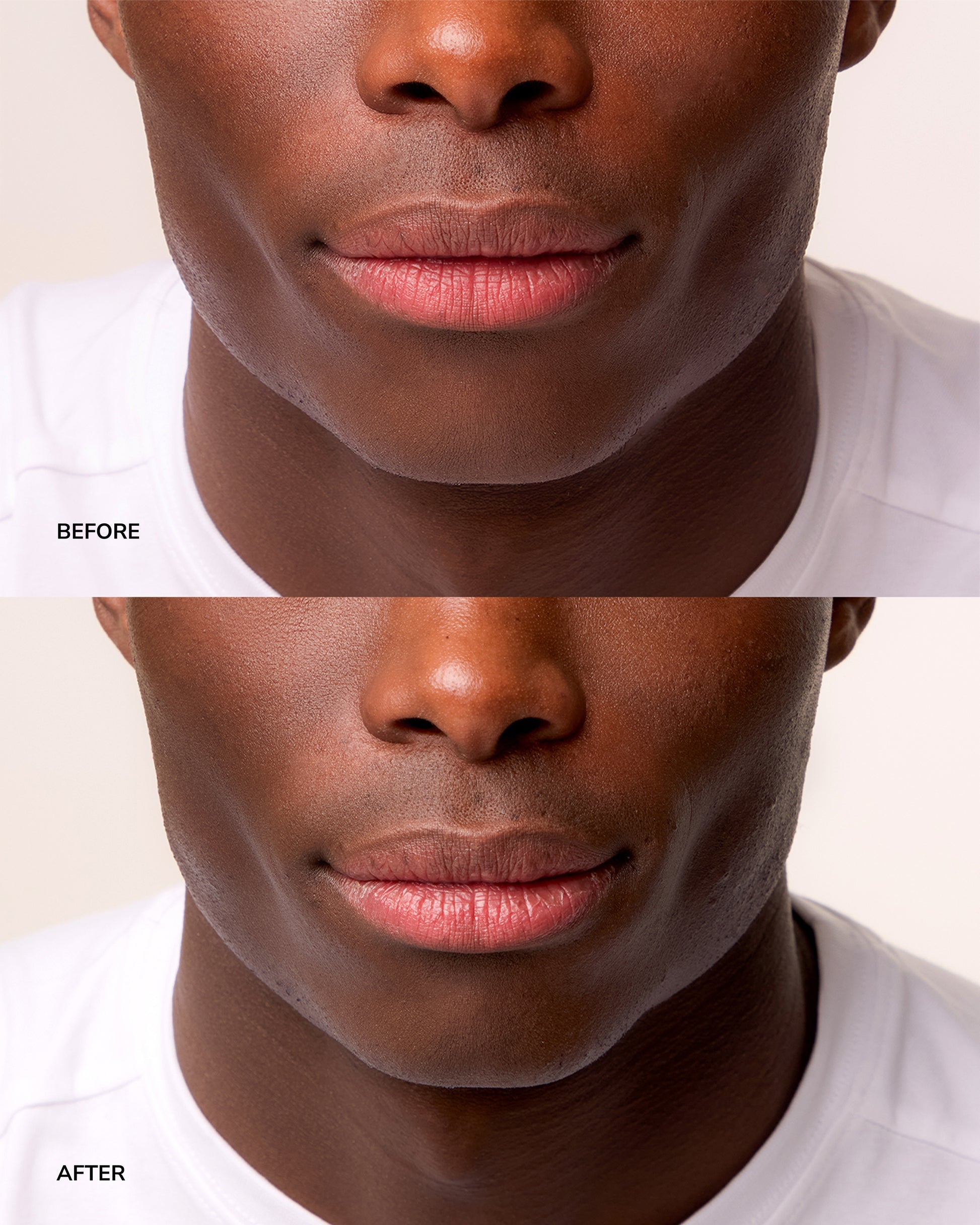 Lip Treatment